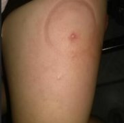 农家蜂蜜_被肿腿蜂蛰了怎么办