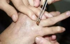 蜂疗怎么做 蜂疗的具体操作方